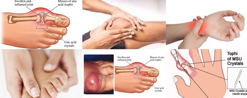 aat Asam Urat dan Kolesterol Menyerang Bersamaan